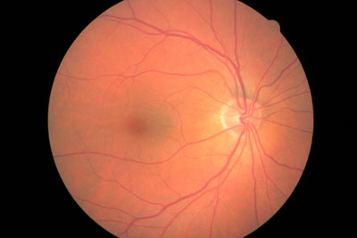 Digital Retinal Photography